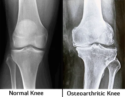 Common signs of Osteoarthritis - Dr. Manoj Kumar Khemani